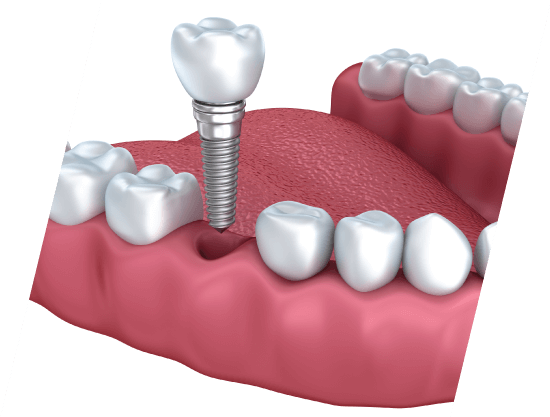 illustration of a dental implant