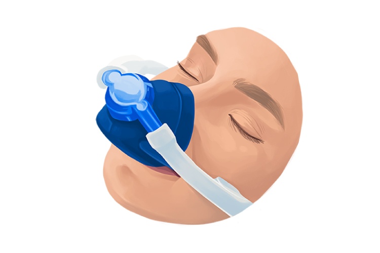 Artistic rendering of a woman's face with a blue mask administering nitrous oxide or laughing gas