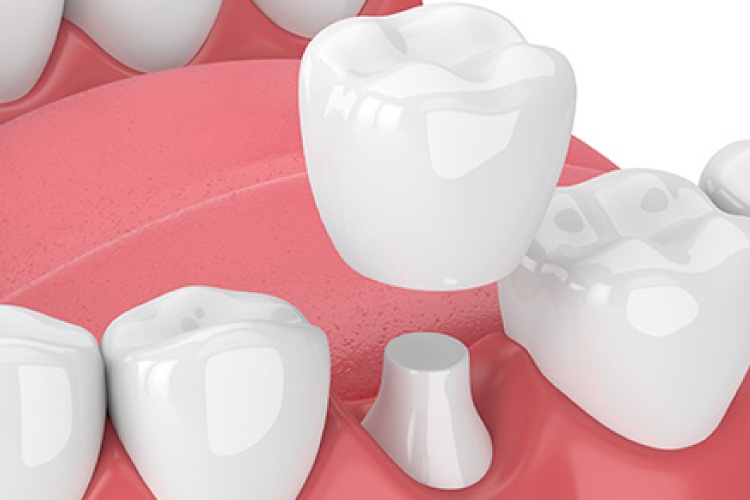 Graphic showing a dental crown being placed on a tooth in the lower jaw