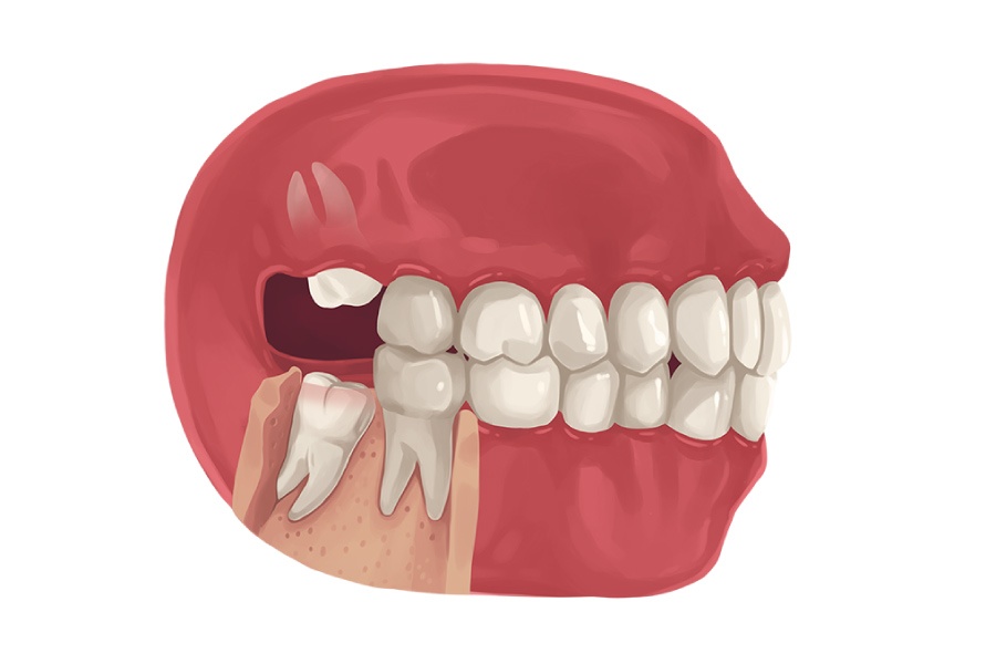 non impacted wisdom teeth