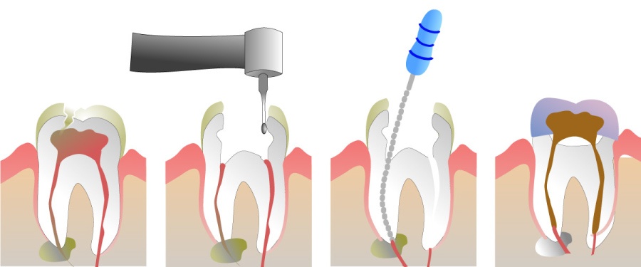 Graphic image showing the steps of root canal therapy