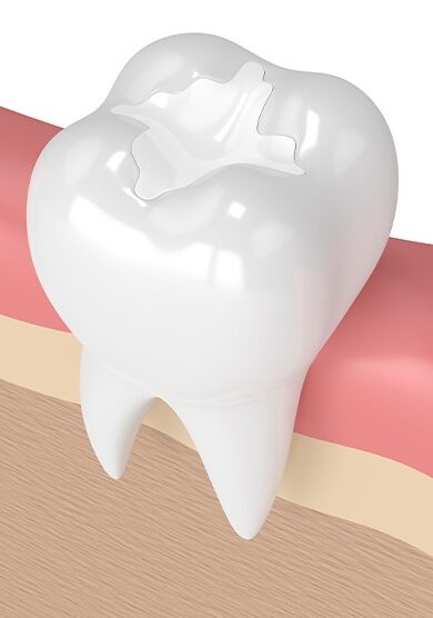 Model of a tooth with a dental sealant