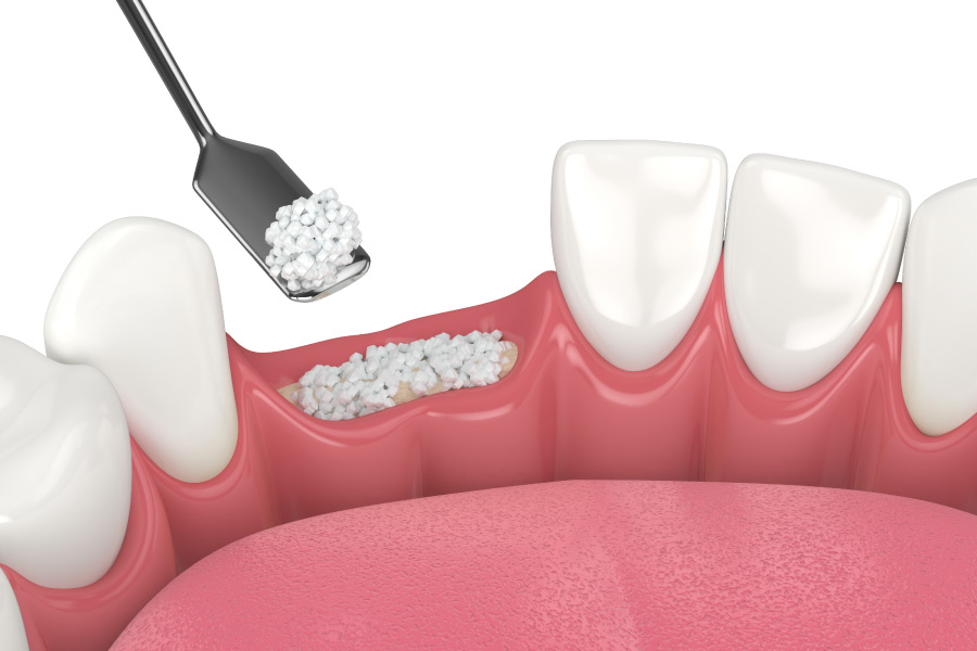 Model showing a bone graft procedure prior to dental implant surgery.