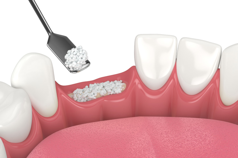 Tips for a Successful Bone Graft | Corvallis Dental Group