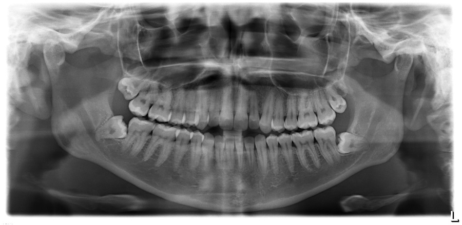 Panoramic X-Ray of 3rd molars or wisdom teeth. 