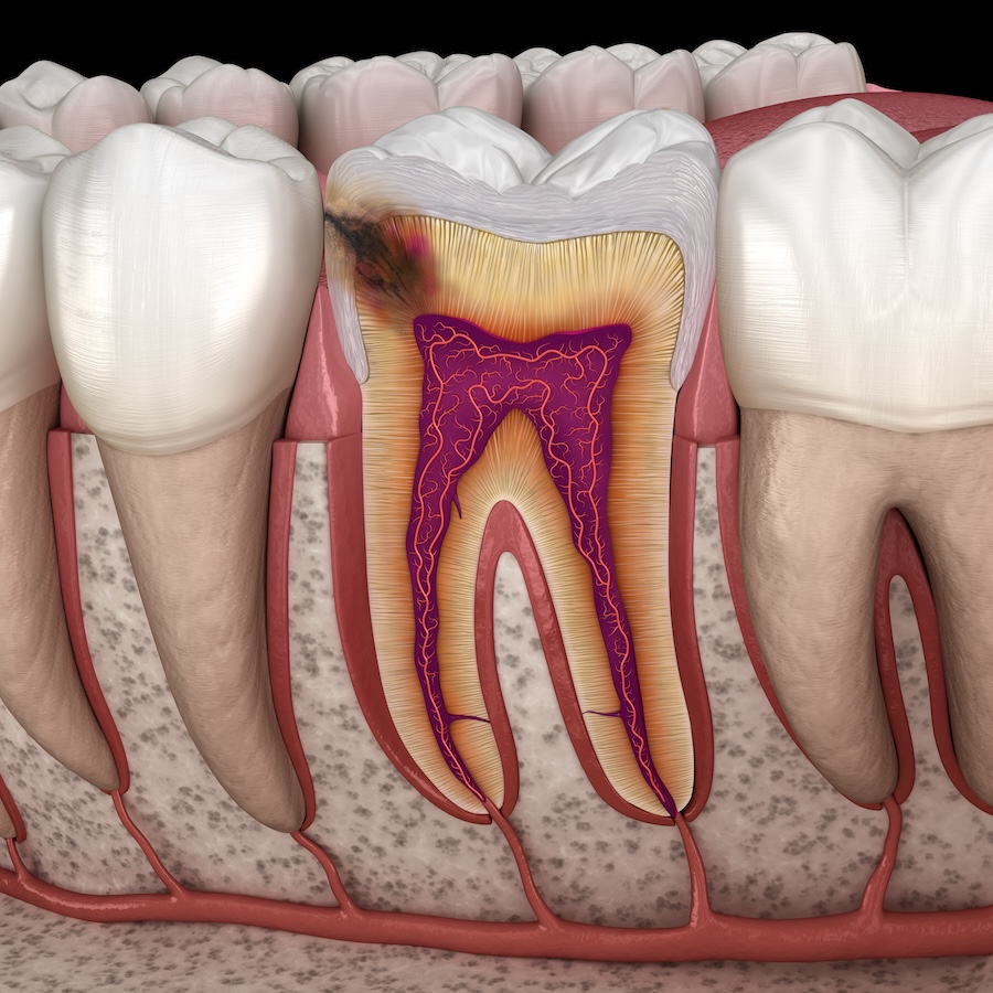 cavities, prevent cavities, reduce cavities, dental care, brushing tips, oral hygiene