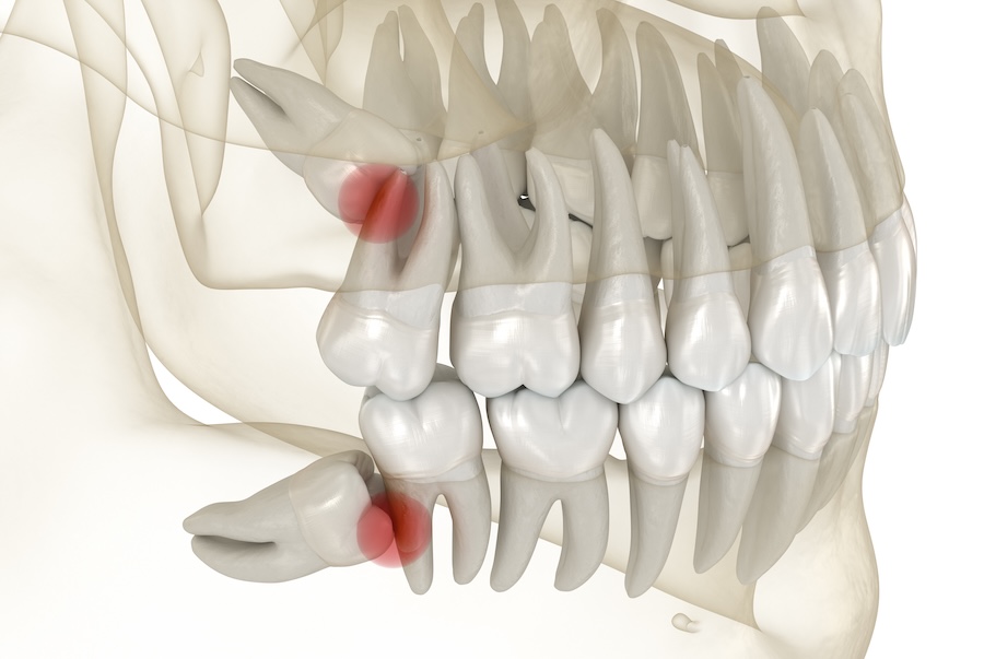 wisdom teeth causing problems, wisdom teeth removal, wisdom tooth removal