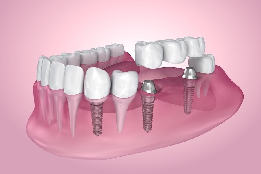 replace missing teeth with dental implants